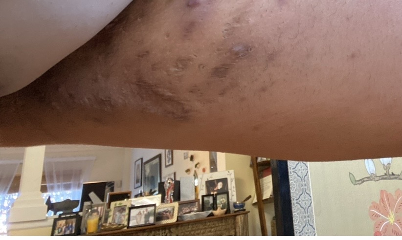 hidradenitis suppurativa